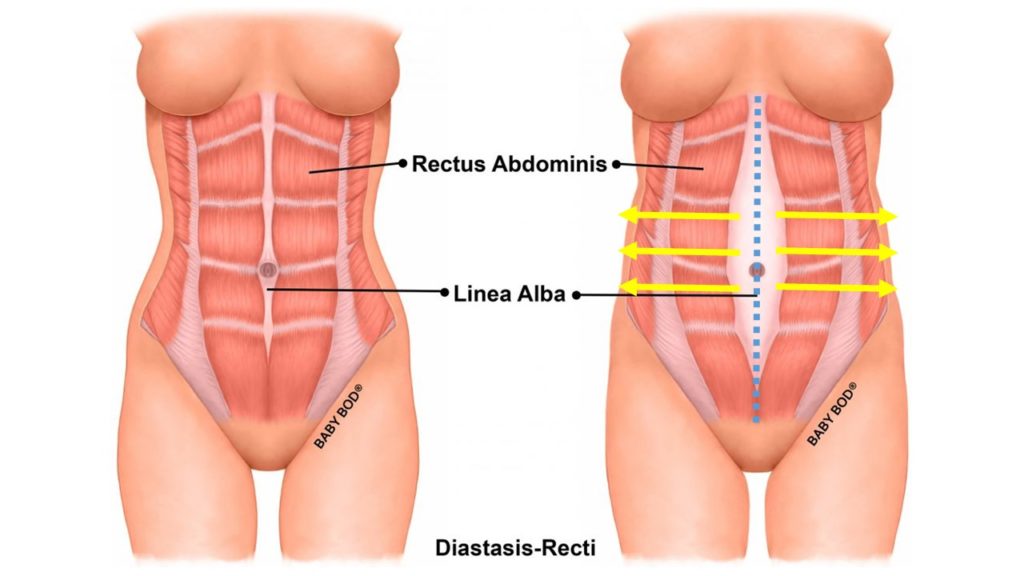 diastasi addominale in gravidanza